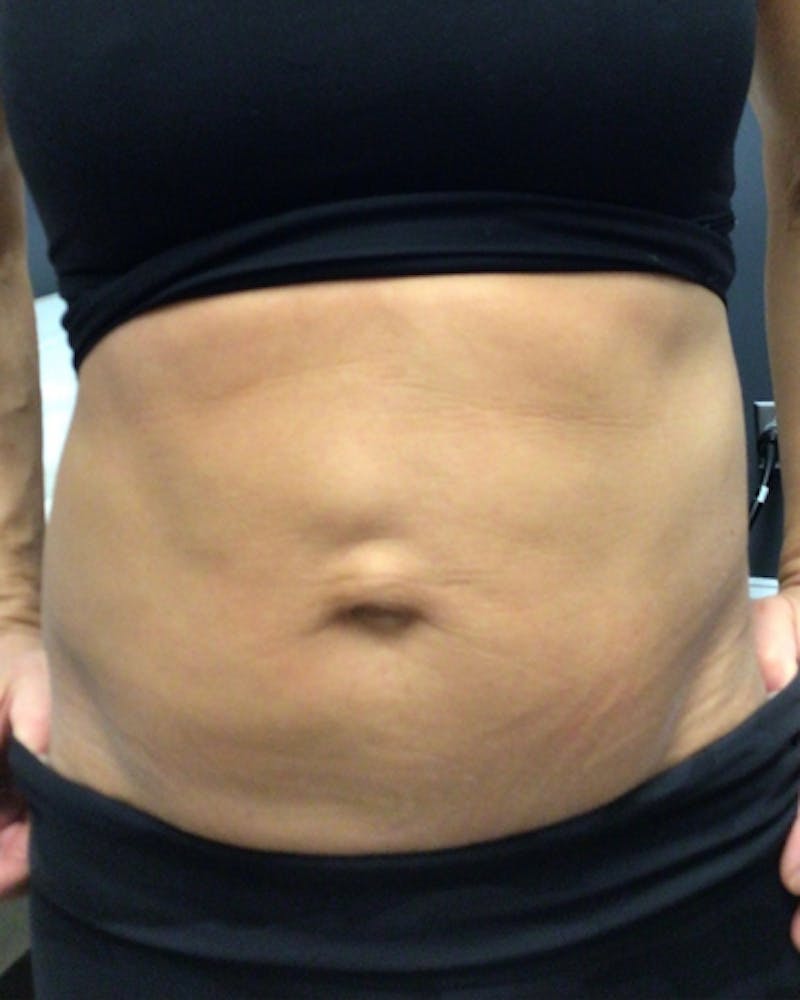 Thermage Before & After Gallery - Patient 343916 - Image 2