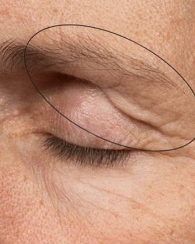 Thermage Before & After Gallery - Patient 326861 - Image 1