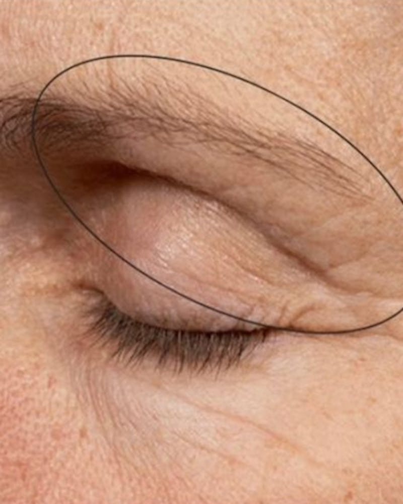 Thermage Before & After Gallery - Patient 326861 - Image 2