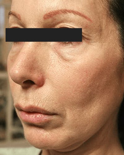 Thermage Before & After Gallery - Patient 115152 - Image 1