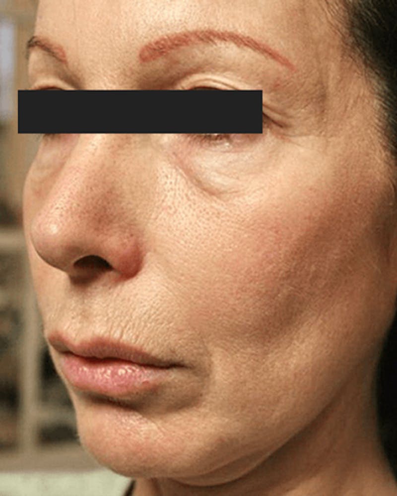 Thermage Before & After Gallery - Patient 115152 - Image 1