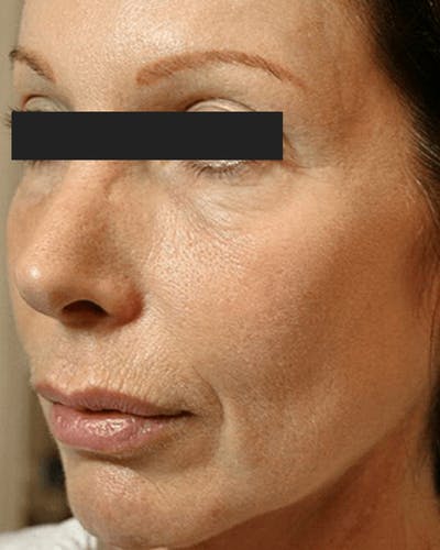 Thermage Before & After Gallery - Patient 115152 - Image 2