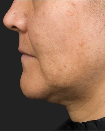 Thermage Before & After Gallery - Patient 341646 - Image 1