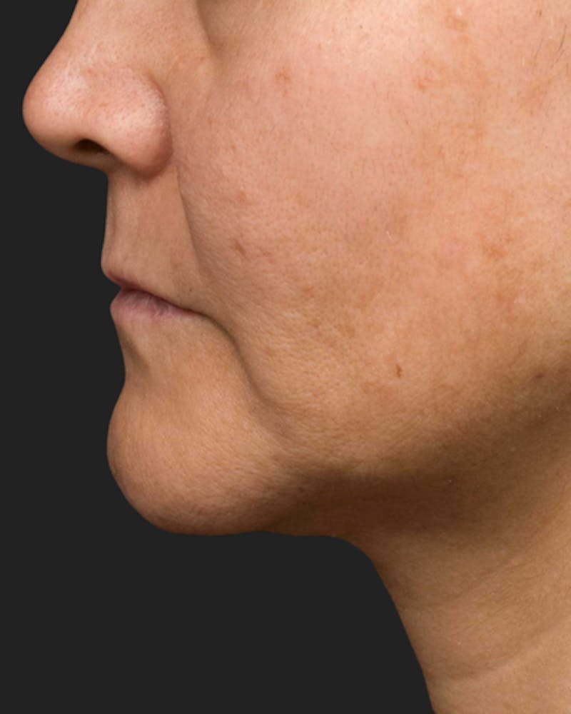 Thermage Before & After Gallery - Patient 341646 - Image 2