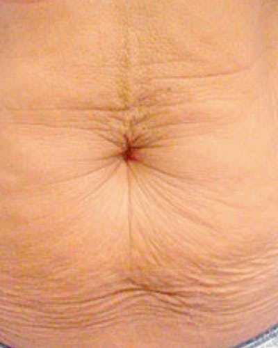 Thermage Before & After Gallery - Patient 124074 - Image 1