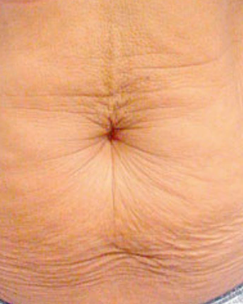 Thermage Before & After Gallery - Patient 124074 - Image 1