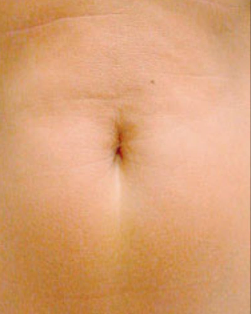 Thermage Before & After Gallery - Patient 124074 - Image 2
