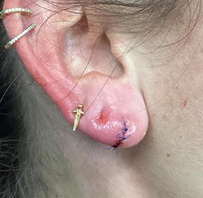 Torn Earlobe Repair Before & After Gallery - Patient 171413 - Image 1