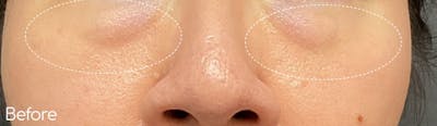 Under-Eye Hollows and Tear-Through Before & After Gallery - Patient 168618 - Image 1