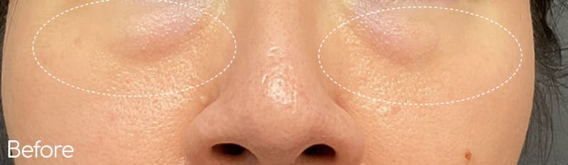 Under-Eye Hollows and Tear-Through Before & After Gallery - Patient 168618 - Image 1