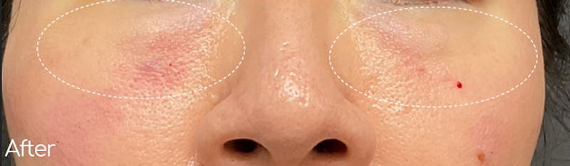 Under-Eye Hollows and Tear-Through Before & After Gallery - Patient 168618 - Image 2