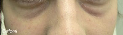 Under-Eye Hollows and Tear-Through Before & After Gallery - Patient 486280 - Image 1