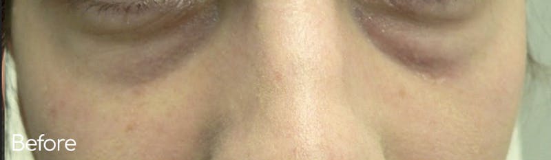 Under-Eye Hollows and Tear-Through Before & After Gallery - Patient 486280 - Image 1