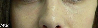 Under-Eye Hollows and Tear-Through Before & After Gallery - Patient 486280 - Image 2