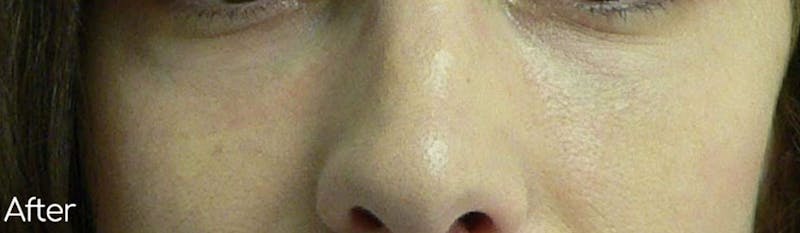 Under-Eye Hollows and Tear-Through Before & After Gallery - Patient 486280 - Image 2