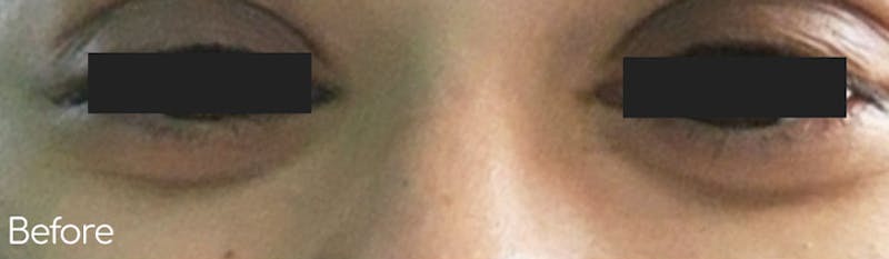 Under-Eye Hollows and Tear-Through Before & After Gallery - Patient 178788 - Image 1
