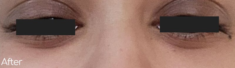 Under-Eye Hollows and Tear-Through Before & After Gallery - Patient 178788 - Image 2