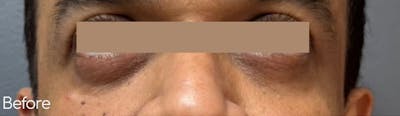 Under-Eye Hollows and Tear-Through Before & After Gallery - Patient 644645 - Image 1