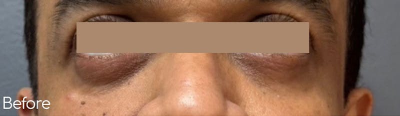 Under-Eye Hollows and Tear-Through Before & After Gallery - Patient 644645 - Image 1