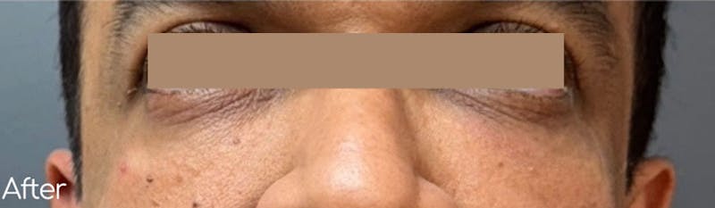 Under-Eye Hollows and Tear-Through Before & After Gallery - Patient 644645 - Image 2