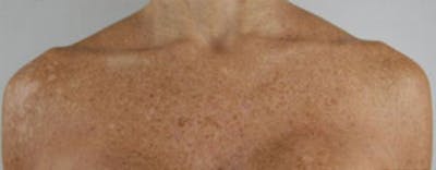 Vi Peel Body Before & After Gallery - Patient 363896 - Image 1