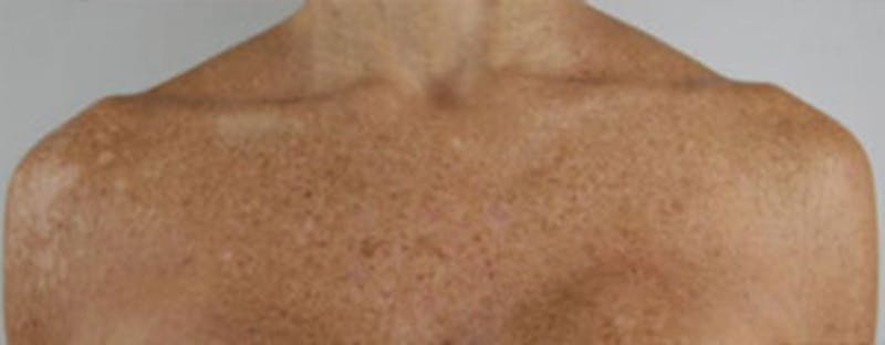 Vi Peel Body Before & After Gallery - Patient 363896 - Image 1