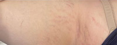 Vi Peel Body Before & After Gallery - Patient 363896 - Image 2