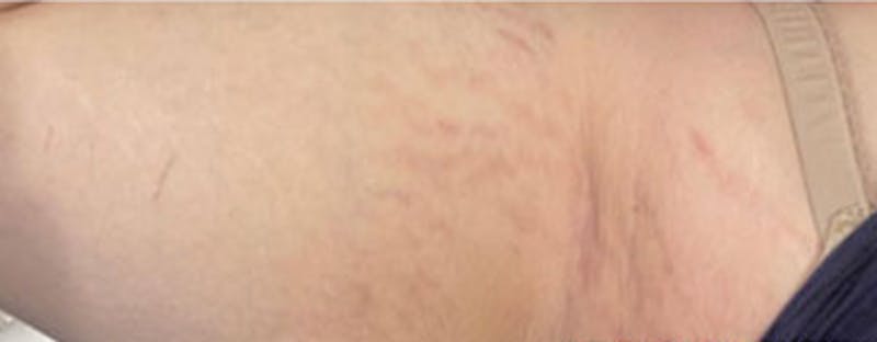Vi Peel Body Before & After Gallery - Patient 363896 - Image 2