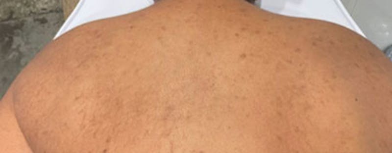 Vi Peel Body Before & After Gallery - Patient 736906 - Image 2