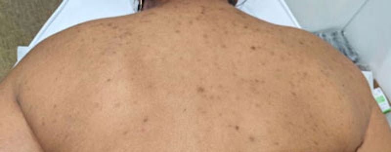 Vi Peel Body Before & After Gallery - Patient 447810 - Image 1