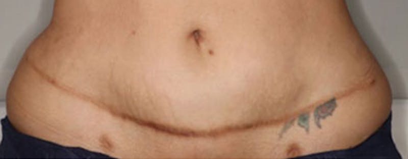 Vi Peel Body Before & After Gallery - Patient 383646 - Image 1