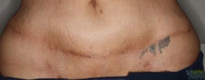 Vi Peel Body Before & After Gallery - Patient 383646 - Image 2