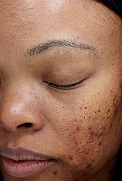 Vi Peel Skin Rejuvenation Before & After Gallery - Patient 867376 - Image 1