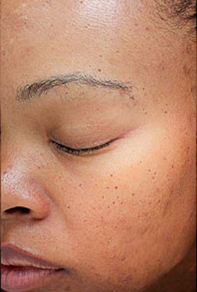 Vi Peel Skin Rejuvenation Before & After Gallery - Patient 867376 - Image 2