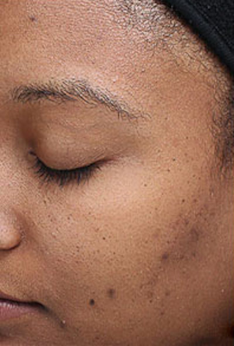 Vi Peel Skin Rejuvenation Before & After Gallery - Patient 328725 - Image 1