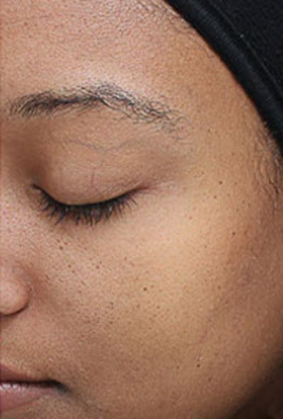 Vi Peel Skin Rejuvenation Before & After Gallery - Patient 328725 - Image 2