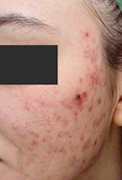 Vi Peel Skin Rejuvenation Before & After Gallery - Patient 226477 - Image 1