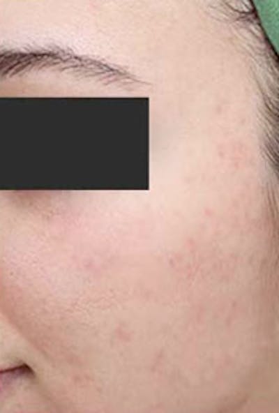 Vi Peel Skin Rejuvenation Before & After Gallery - Patient 226477 - Image 2