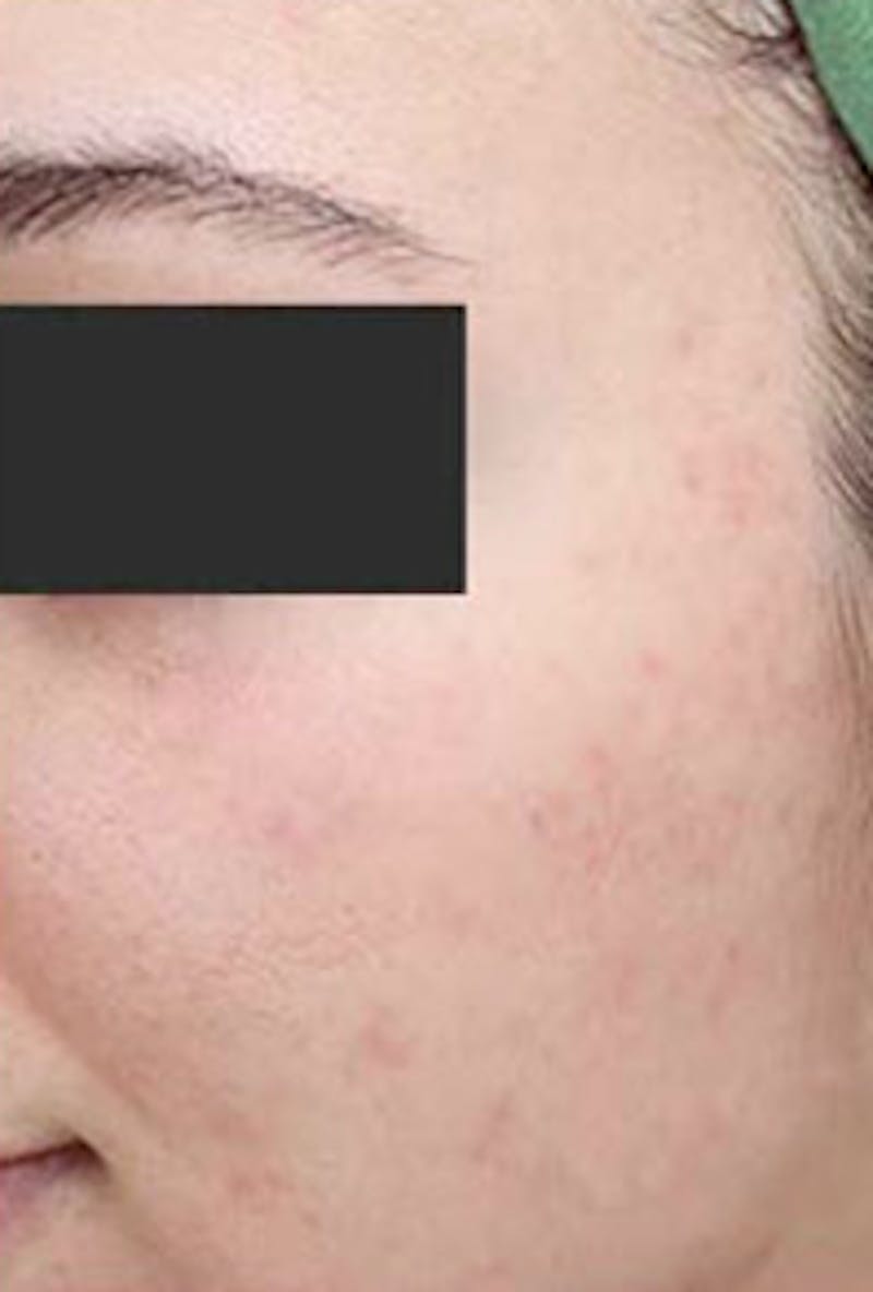 Vi Peel Skin Rejuvenation Before & After Gallery - Patient 226477 - Image 2