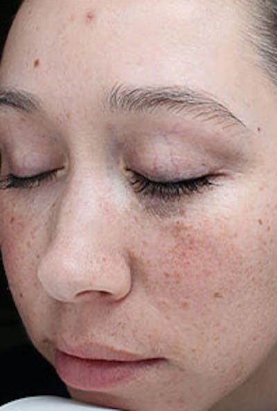 Vi Peel Skin Rejuvenation Before & After Gallery - Patient 130275 - Image 1