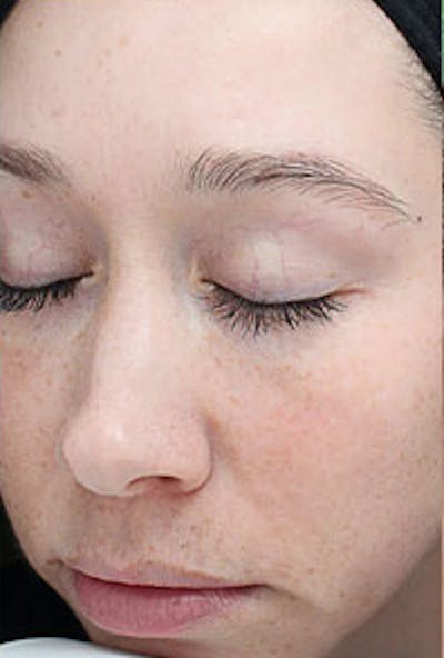 Vi Peel Skin Rejuvenation Before & After Gallery - Patient 130275 - Image 2