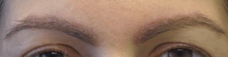 Eyebrow Transplant Before & After Gallery - Patient 233377 - Image 2