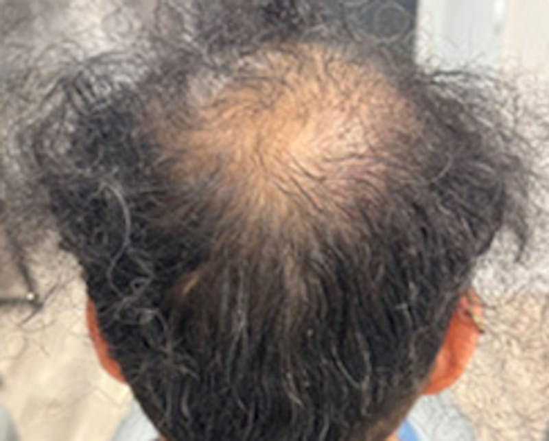 Injections for Hair Loss (PRFM) Before & After Gallery - Patient 228542 - Image 1