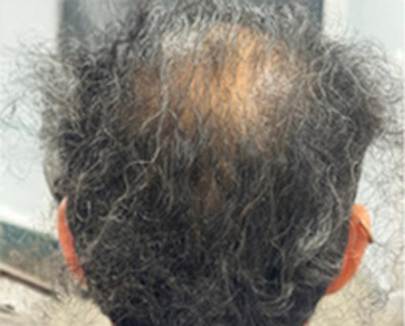 Injections for Hair Loss (PRFM) Before & After Gallery - Patient 228542 - Image 2
