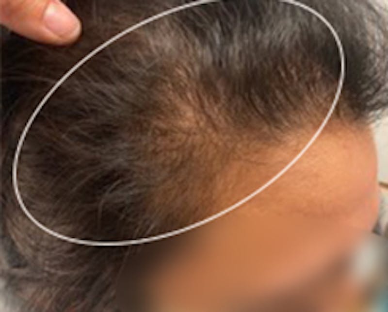 Injections for Hair Loss (PRFM) Before & After Gallery - Patient 261340 - Image 1