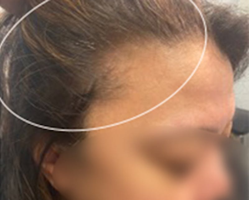Injections for Hair Loss (PRFM) Before & After Gallery - Patient 261340 - Image 2