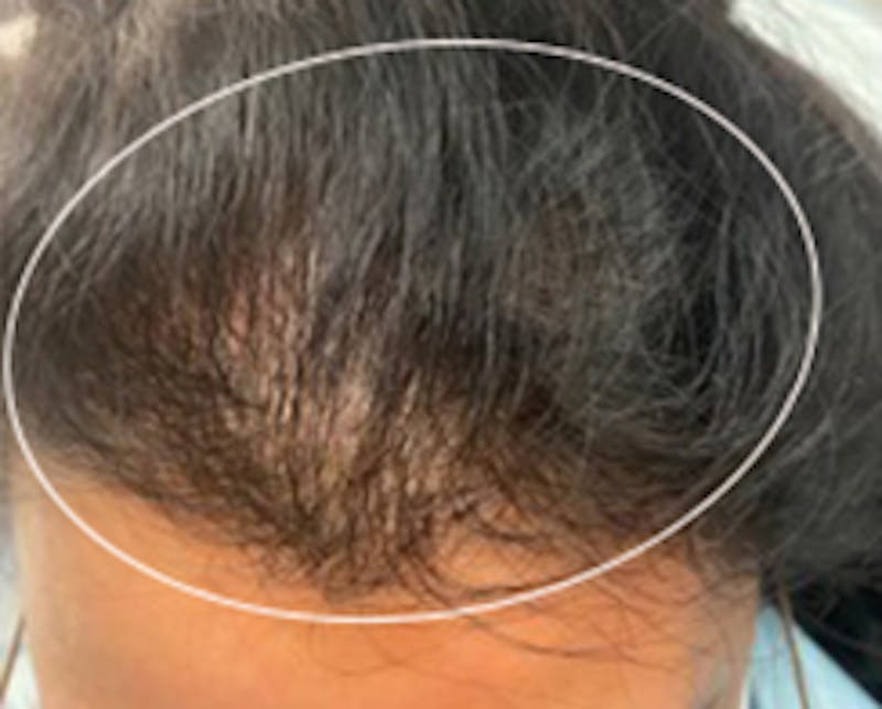Injections for Hair Loss (PRFM) Before & After Gallery - Patient 158942 - Image 1
