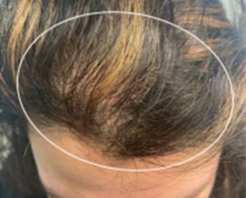 Injections for Hair Loss (PRFM) Before & After Gallery - Patient 158942 - Image 2