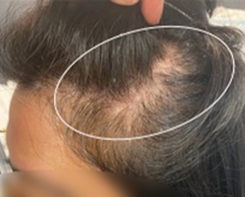 Injections for Hair Loss (PRFM) Before & After Gallery - Patient 182160 - Image 1