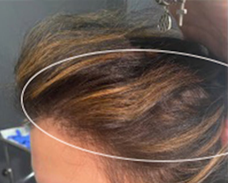 Injections for Hair Loss (PRFM) Before & After Gallery - Patient 182160 - Image 2